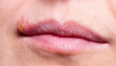 herpes-virus-sistema-nervoso