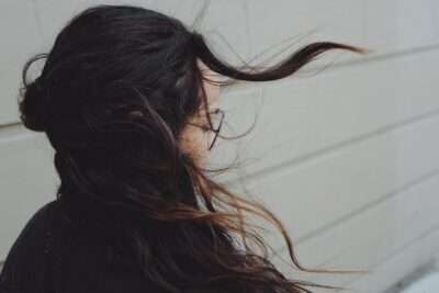 alopecia (2)