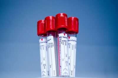 infarto ictus esame del sangue