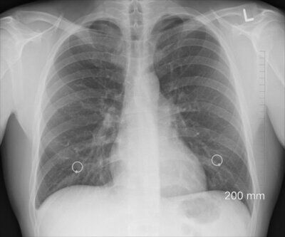 cancro polmoni inquinamento atmosferico