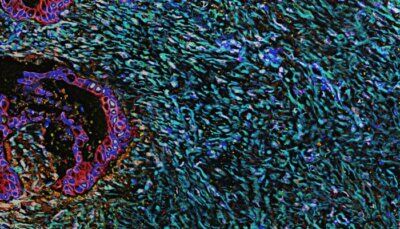 cancro-gel-radioattivo-pancreas