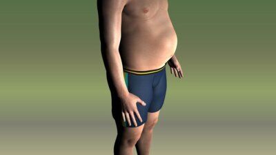 obesità disturbo neurologico