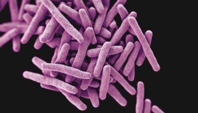 tubercolosi-infezione-letale-morte
