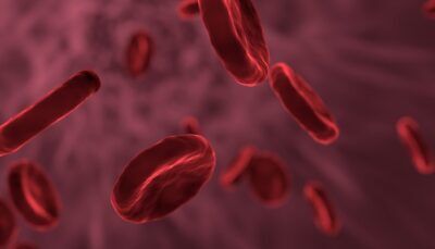 alzheimer-morbo-esame-sangue