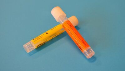 cancro-cervello-urina-diagnosi