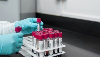 sangue-gruppo-probabilità-ictus