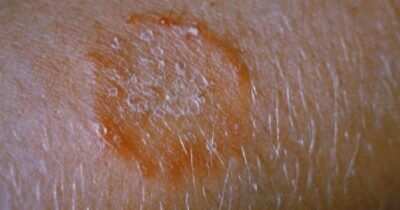tigna-resistente-farmaci-cdc