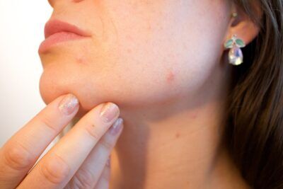 zucchero acne