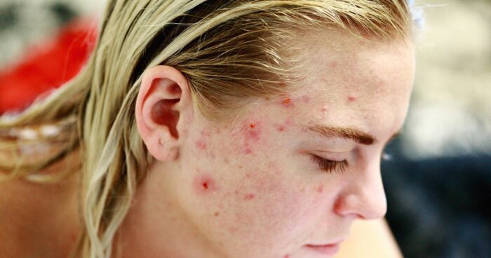 acne-composto-combattere-pelle