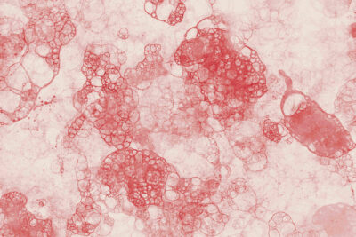 anemia