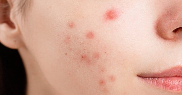 acne-batteri-brufoli-dna