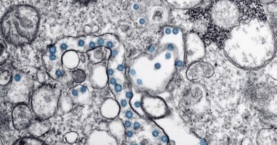 alzheimer-virus-prove-cervello