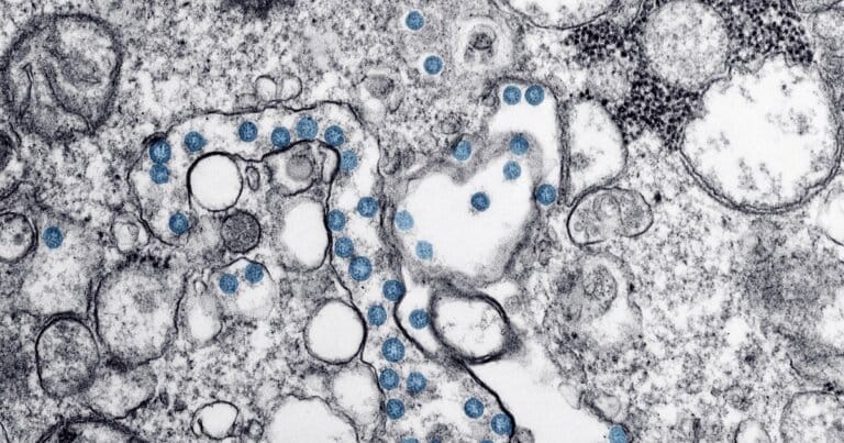 alzheimer-virus-prove-cervello