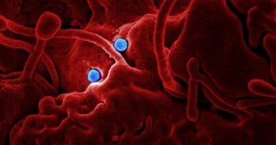 demenza-semplice-virus-herpes