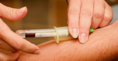 demenza-test-sangue-diagnosi