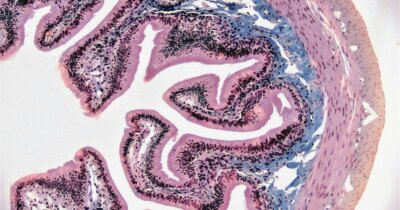 alzheimer-cambiamento-intestino-batteri