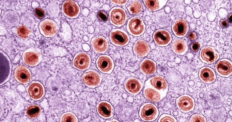 herpes-alzheimer-collegamento-salute
