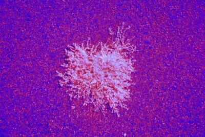 fungo leucemia