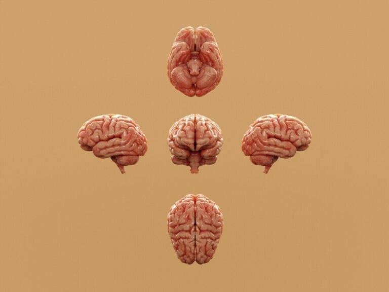 cellule cerebrali sclerosi multipla