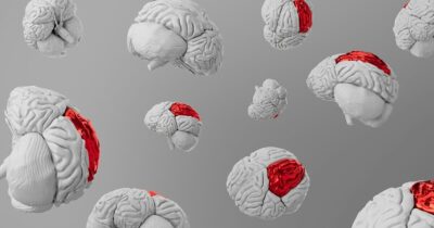 alzheimer-proteina-cervello-salute
