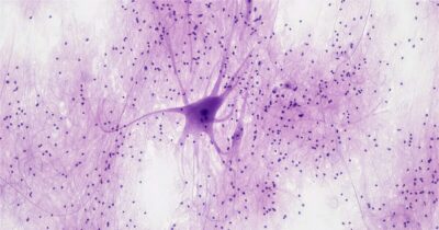 neuroni-alzheimer-cervello-connessione