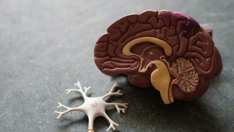 alzheimer forma cervello