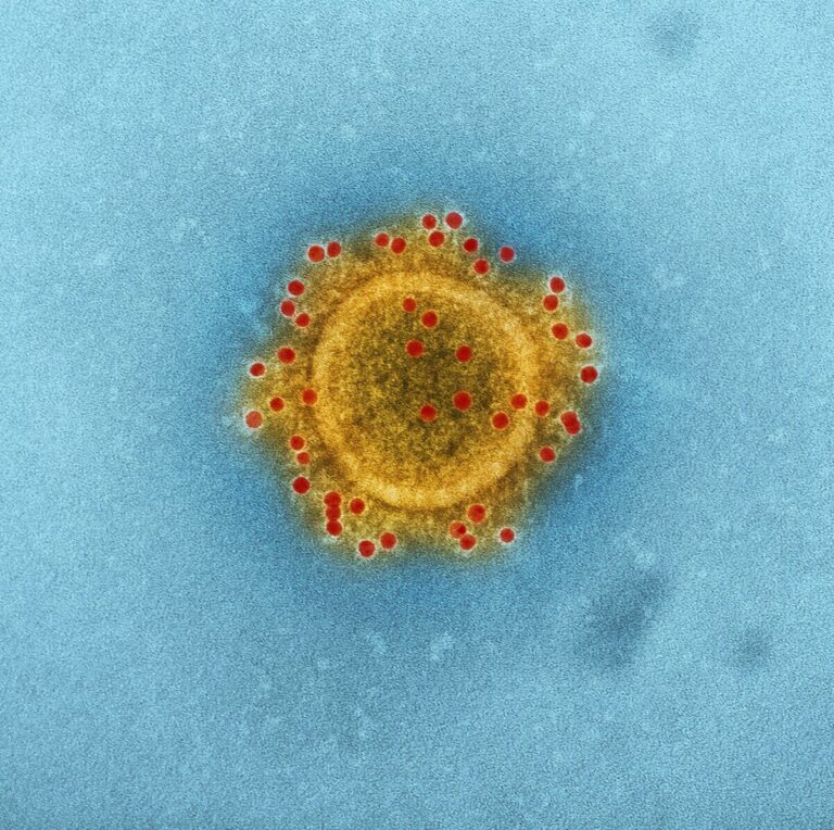 virus Epistein-Barr lupus