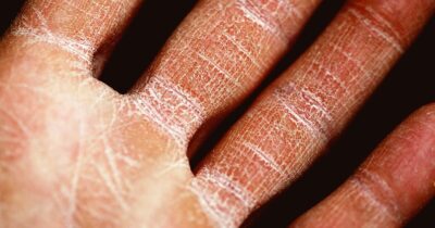 eczema-farmaco-alleviare-sintomi