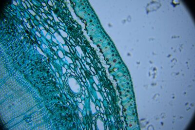 glioblastoma ipertensione cure