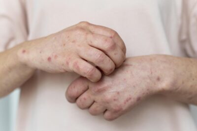 morbillo stati uniti